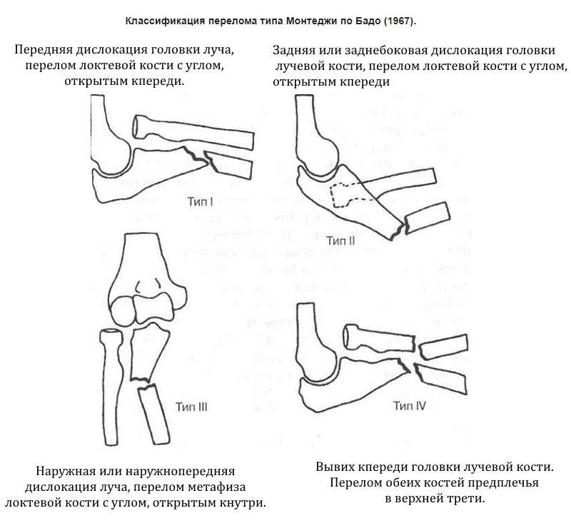 Переломы костей
