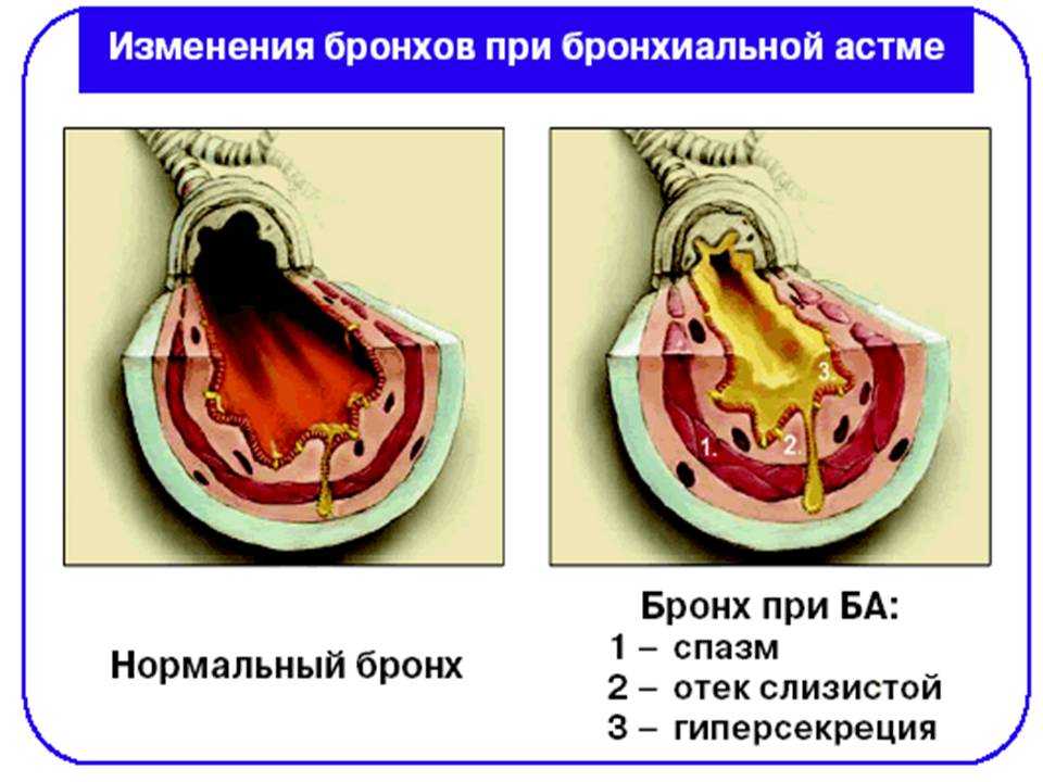 Бронхиальная астма