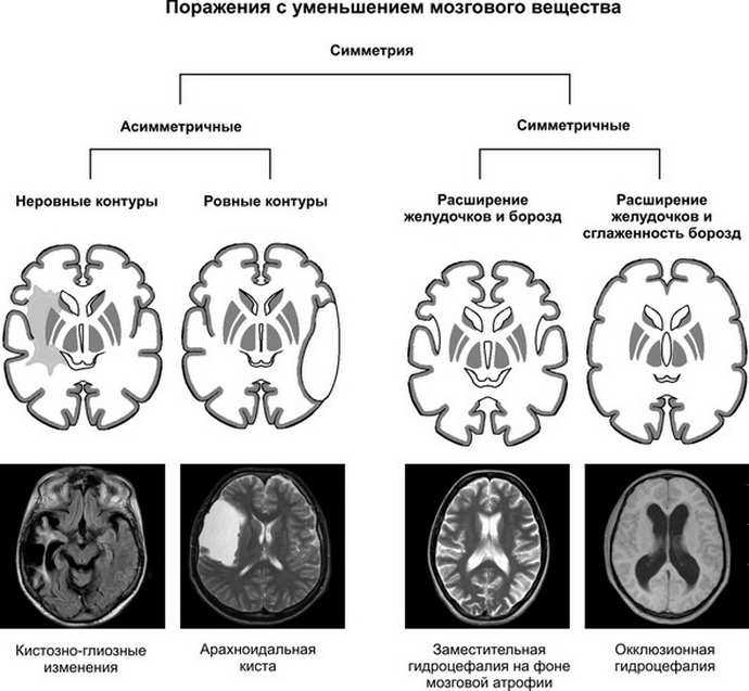 Атрофия мозга симптомы. Кистозно-глиозные изменения головного мозга кт. Кистозно-глиозная трансформация головного мозга на кт. Кистозно-глиозная трансформация головного мозга что это такое. Единичные очаги глиозной трансформации головного мозга.