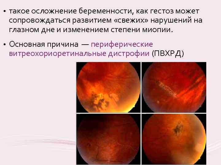 Лекция 3. дистрофии