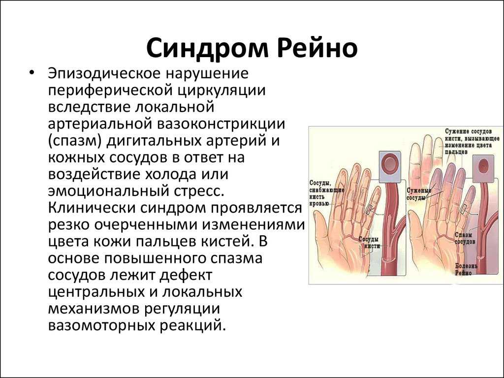 Синдром рейно: что это такое, симптомы, лечение, прогноз