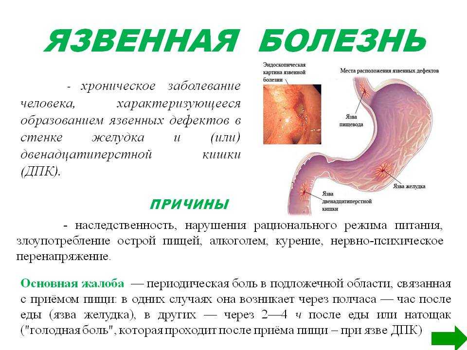 Язвенная болезнь / заболевания / клиника эксперт