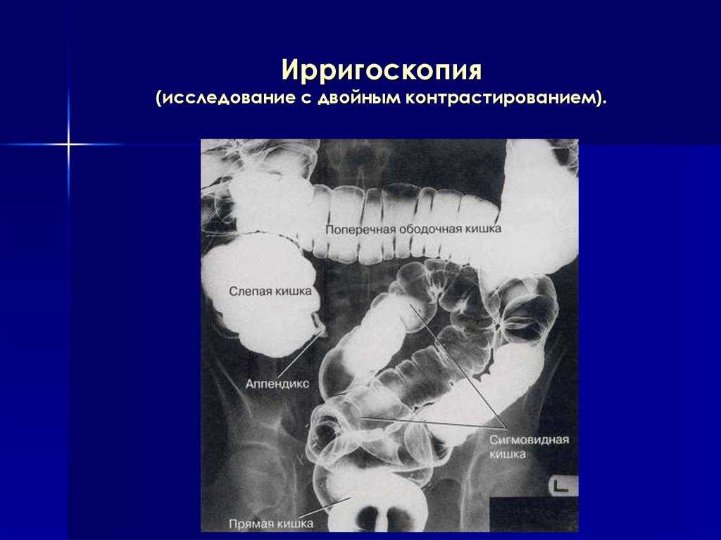 Исследование с 2 с. Двойное контрастирование толстой кишки. Ирригоскопия. Двойное контрастирование толстой кишки. Ирригоскопия с двойным контрастированием. Двойное контрастирование толстой кишки рентген.