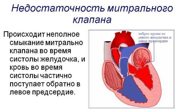 Недостаточность двухстворчатого клапана. Недостаточность двустворчатого (митрального) клапана. Приобретённые пороки сердца митральная недостаточность. Недостаточность двустворчатого клапана сердца. Приобретённые пороки сердца недостаточность митрального клапана.