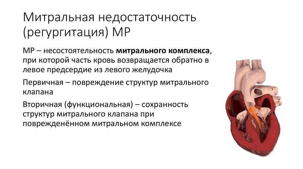Митральная недостаточность 1-4 степени: причины и симптомы, лечение и прогноз жизни