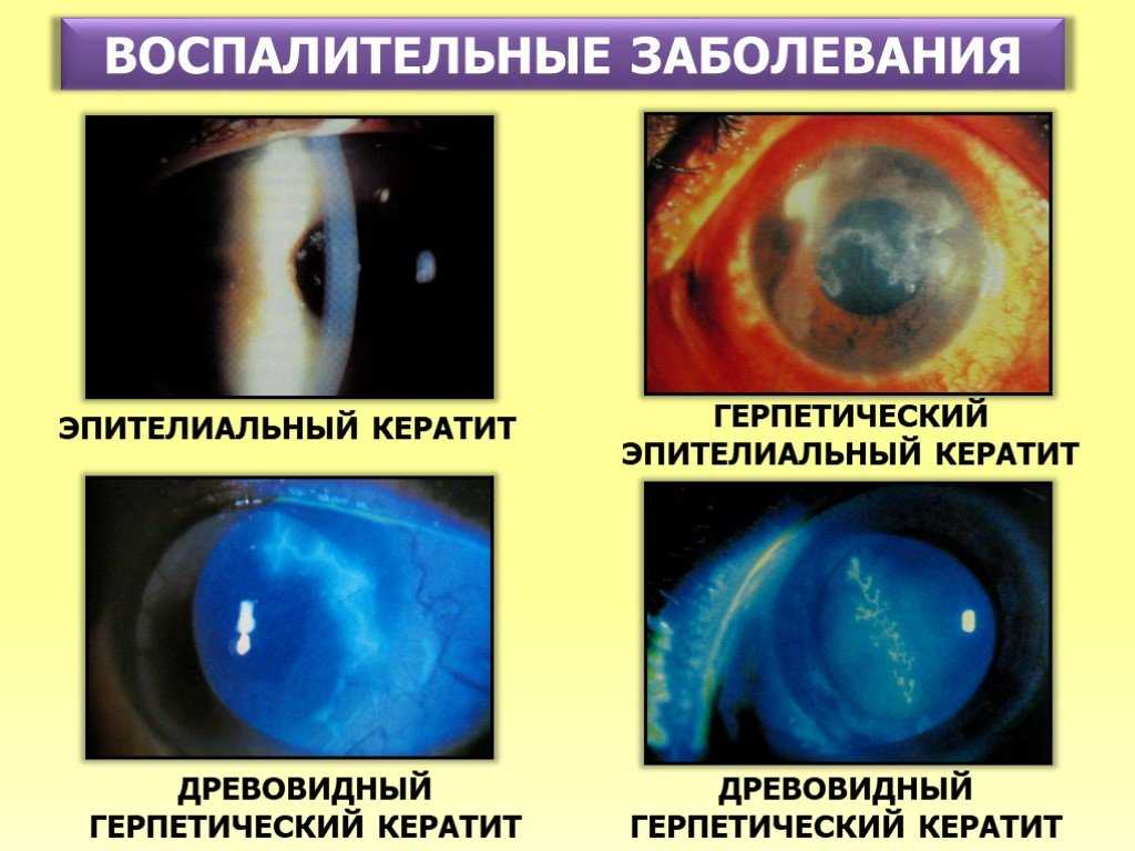 Герпетический язвенный кератит. Древовидный кератит этиология.