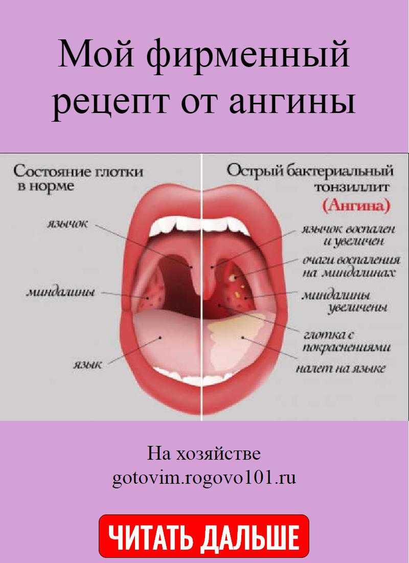 Схема лечения гнойной ангины