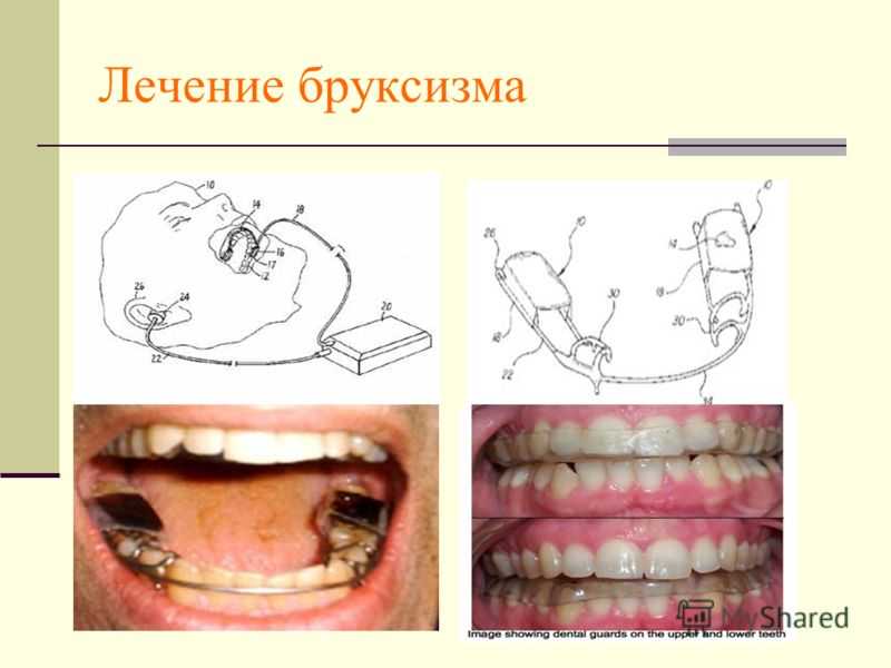 Непроизвольный скрежет зубами и сжимание челюстей - причины, диагностика и лечение бруксизма