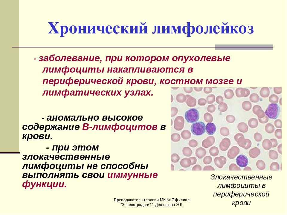 Хр лимфолейкоз картина крови