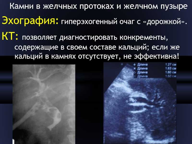 Диета при холецистите