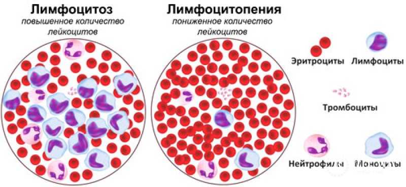 Низкие лимфоциты в крови: причины понижения, симптоматика и лечение лимфопении