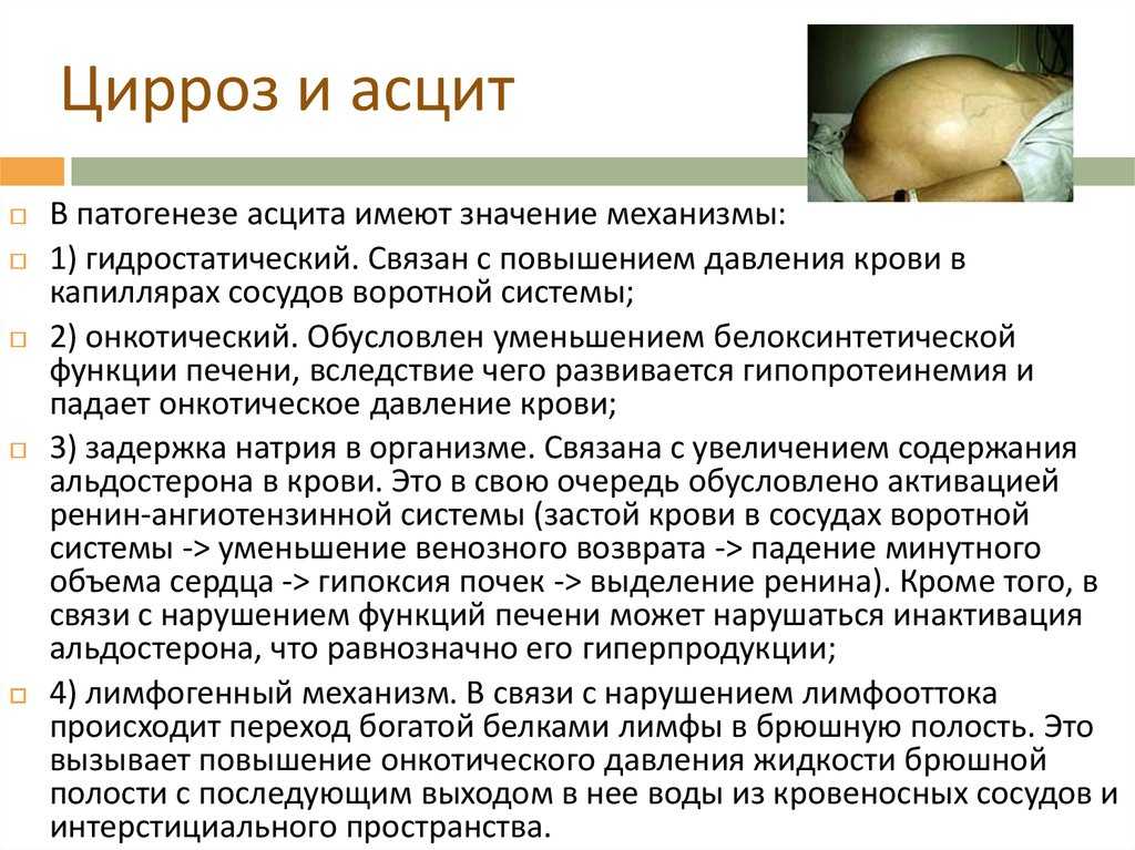 Асцит, часто именуемый брюшная водянка представляет собой патологическое скопление жидкости транссудатаэкссудата в брюшной полости В подавляющем большинстве случаев асцит не является самостоятельным заболеванием, а