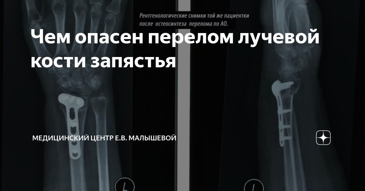 Первая помощь при переломе