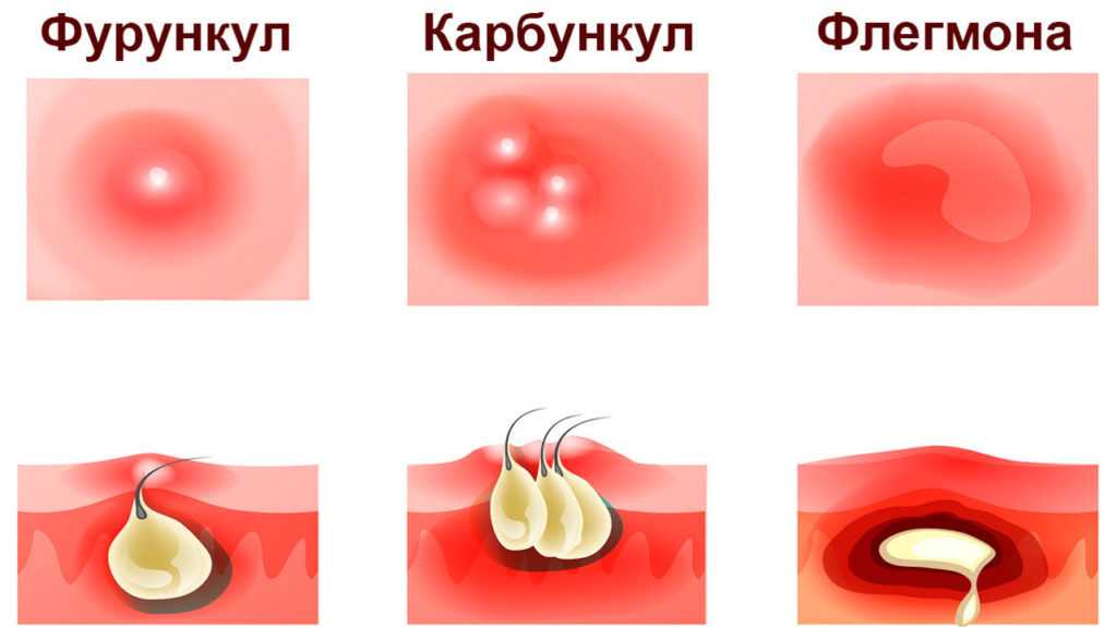Флегмона – причины, симптомы, виды и методы лечения