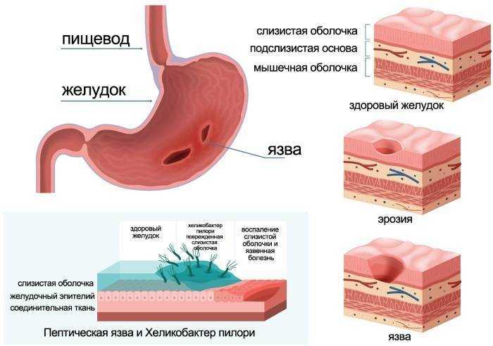 Стеноз выходного отдела желудка и двенадцатиперстной кишки