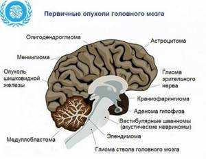Современные методы лечения глиомы головного мозга