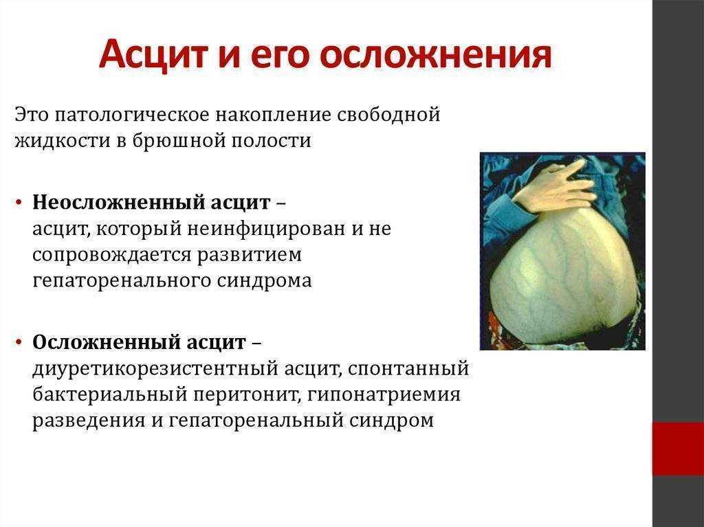 Напряженный асцит: первый признаки, диагностика и лечение асцита в «евроонко» | клиники «евроонко»