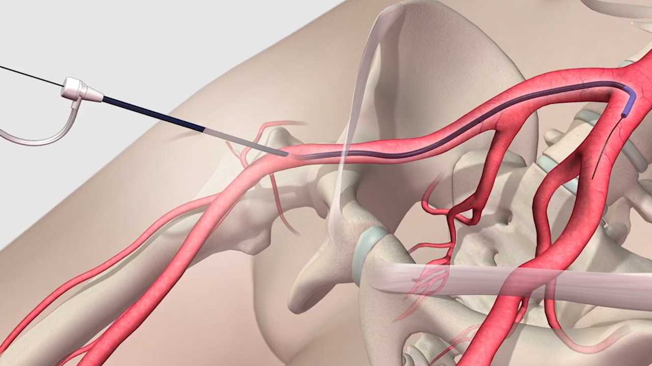 Стент видео. Эндоваскулярное вмешательство на артериях нижних конечностей. Стентирование подвздошной артерии. Эндоваскулярная эмболизация фистулы. Эмболизация аневризмы.