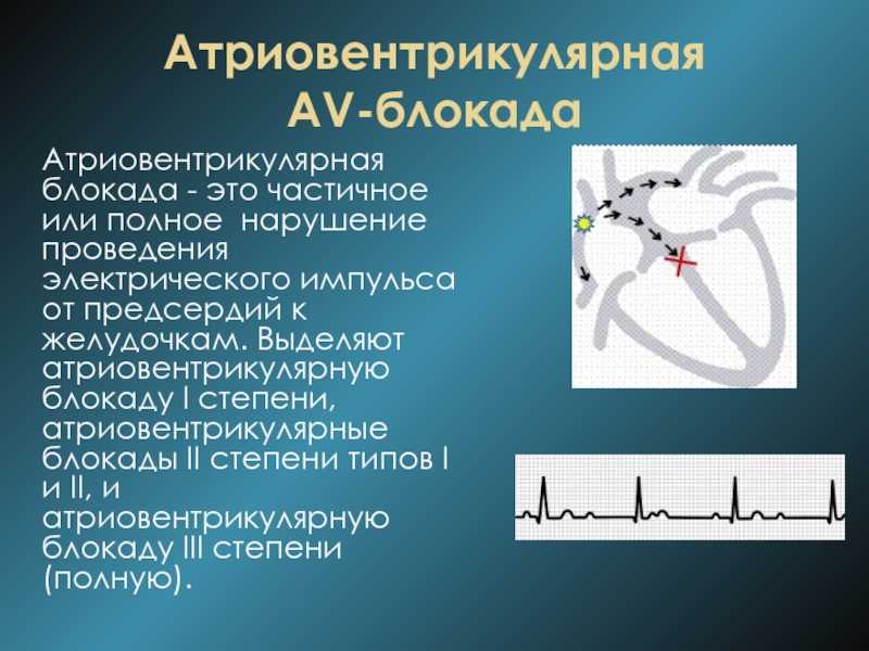 Ав-блокада: причины, симптомы, степени и лечение|gms hospital