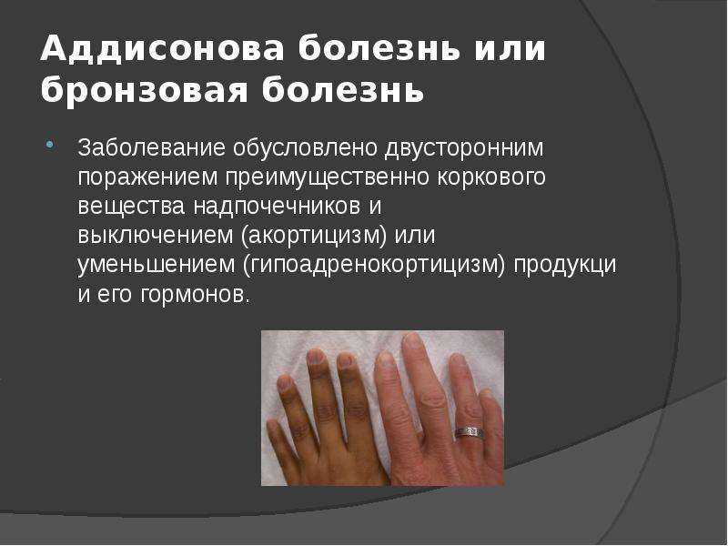 Аддисонов синдром