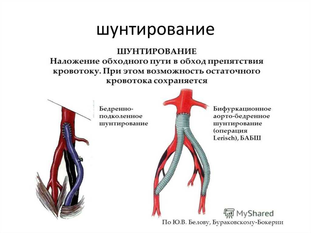 Схема аортокоронарного шунтирования