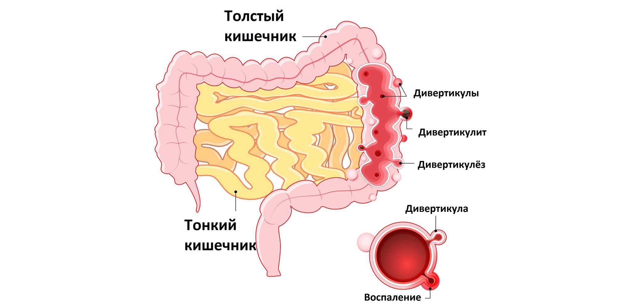 Дивертикулярная болезнь толстой кишки клиника