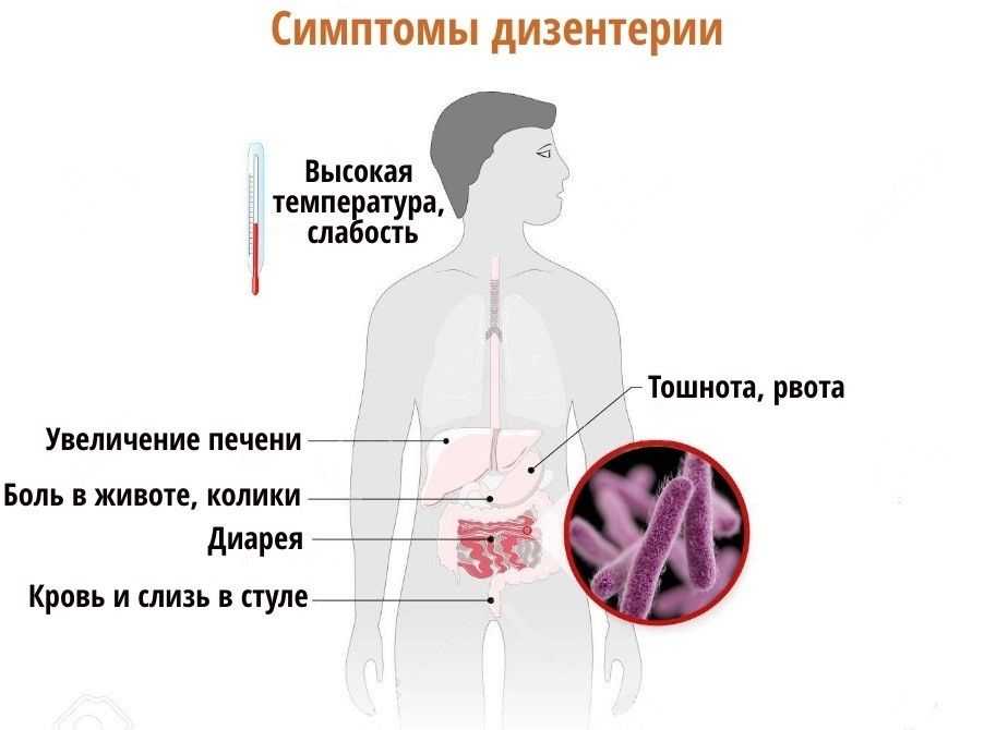 Дизентерия клиническая картина