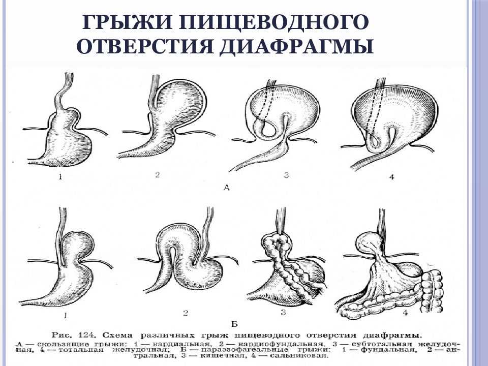 Почему грыжа пищевода