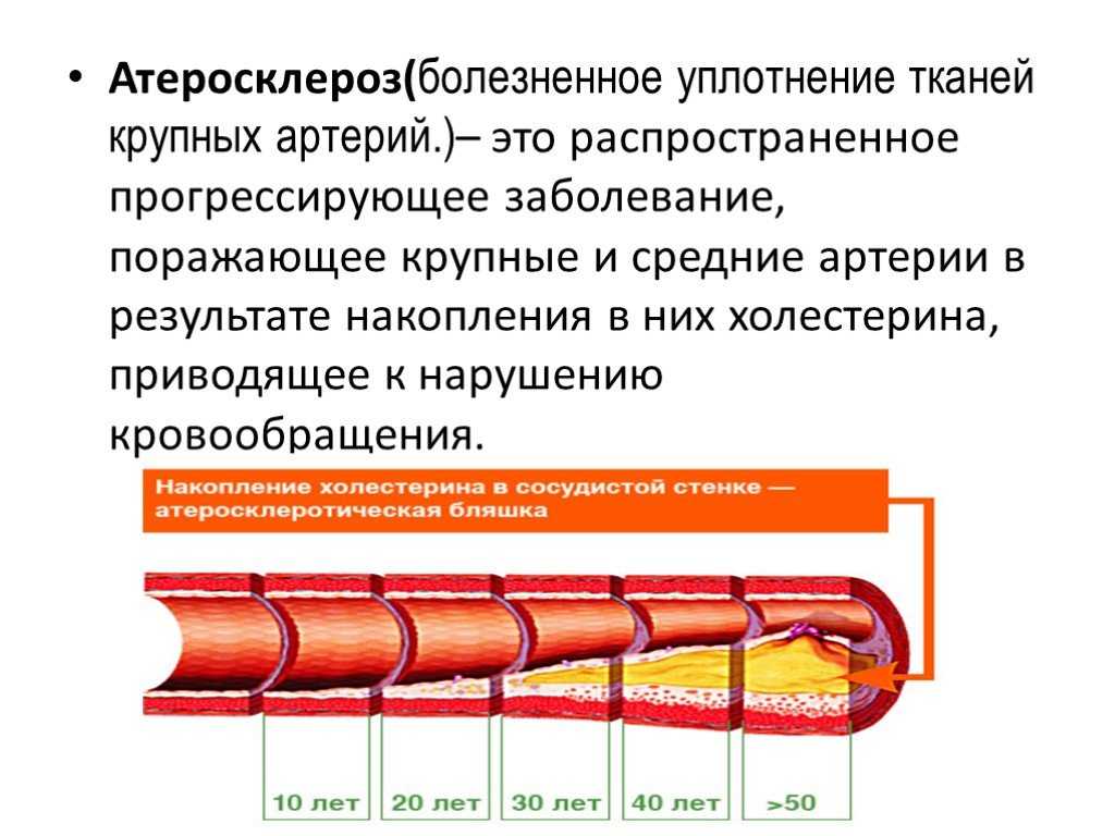 Схема тромбоза при атеросклерозе мозговых артерий