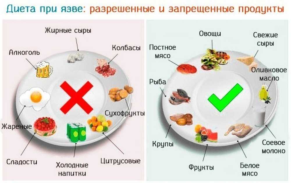 Правила питания при гастрите и язве желудка