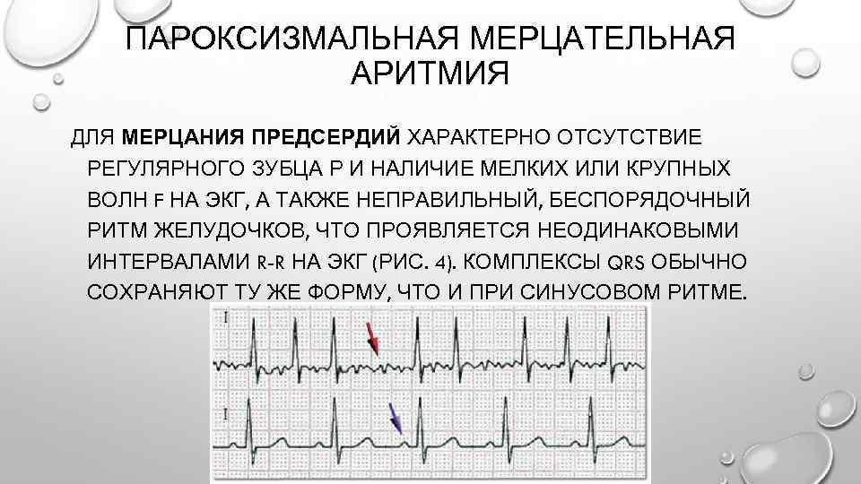 Фибрилляция предсердий картинки