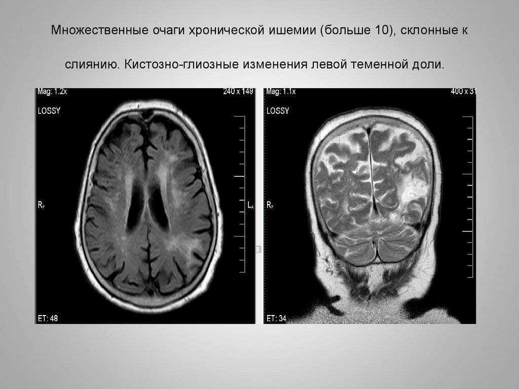 Картина очаговых изменений вещества мозга дисциркуляторного характера и постишемического характера