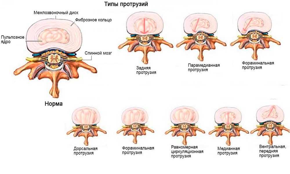 Протрузия диска поясничного отдела позвоночника