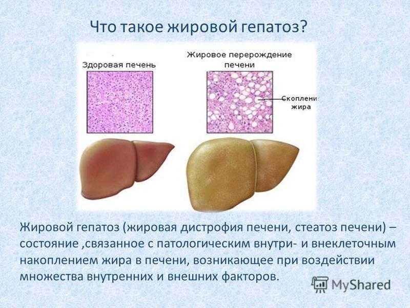 Причины жировой печени. Жирового гепатоза печени. Жировой гепатоз печени симптомы. Жировая дистрофия печени(жировой гепатоз). Тиреотоксический гепатоз.