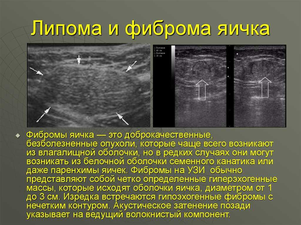 Липома или липосаркома?