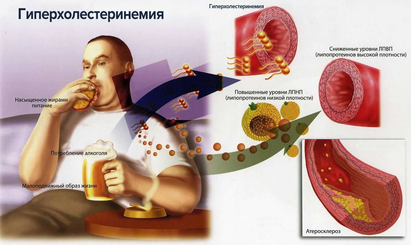 Семейная гиперхолестеринемия презентация