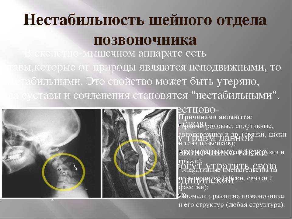 Мр картина нарушения статики шейного отдела позвоночника