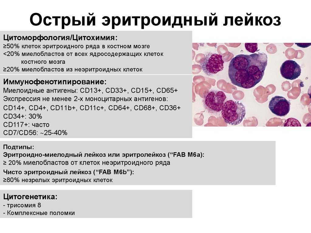 Рак костного мозга: симптомы и проявление у взрослого, сколько живут, лечение опухоли костного мозга | клиники «евроонко»
