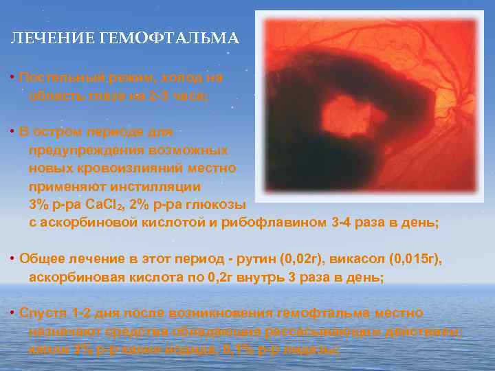 Кровоизлияние в стекловидное тело - википедия