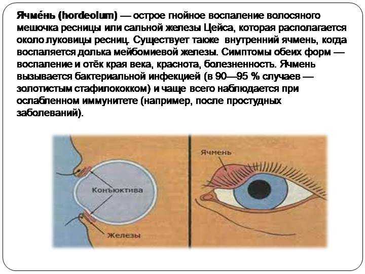 Почему вылазит глаз. Заболевания век ячмень. Как выглядит ячмень на глазу.