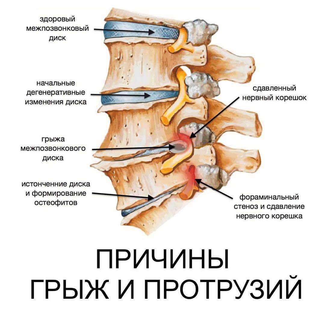 Схема лечения протрузии и грыжи поясничного отдела позвоночника