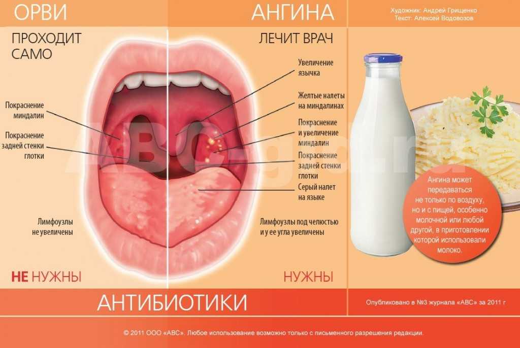 Схема лечения гнойной ангины