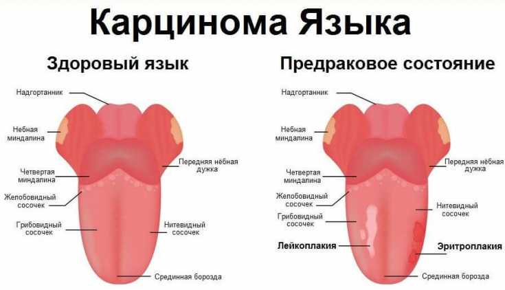 Рак губы — центр медицинского образования