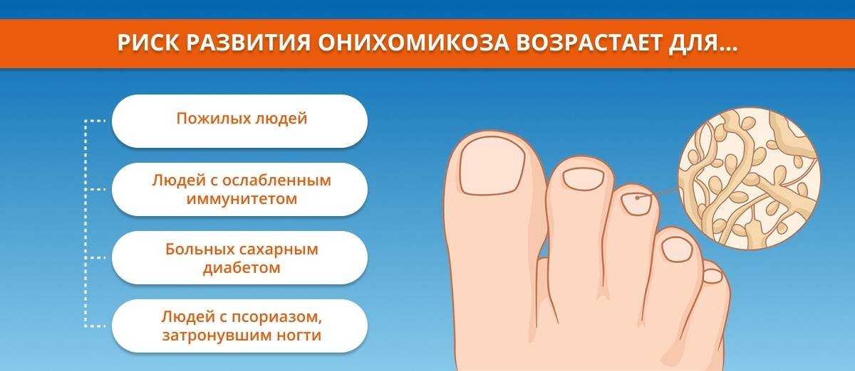 Грибок ногтей на ногах и руках: причины, первые признаки, основные симптомы. лечение онихомикоза в москве