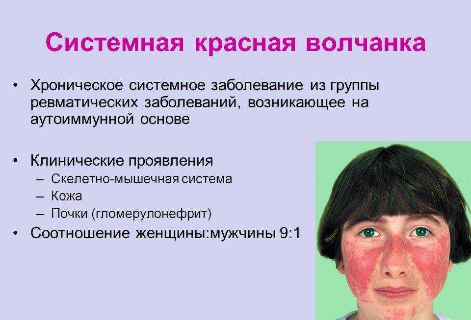 Системная красная волчанка лечение