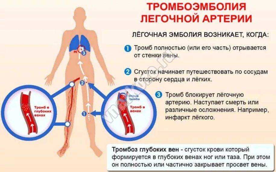 Симптомы тромбоэмболии у женщин