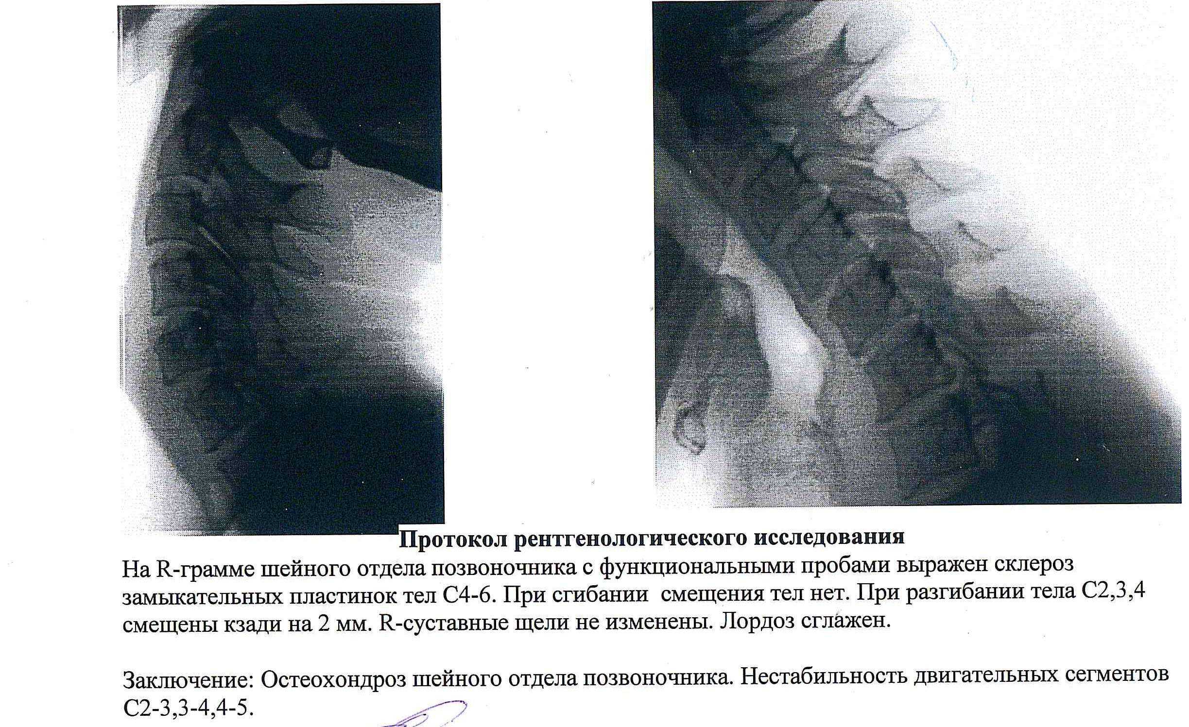 Спинальная нестабильность что это