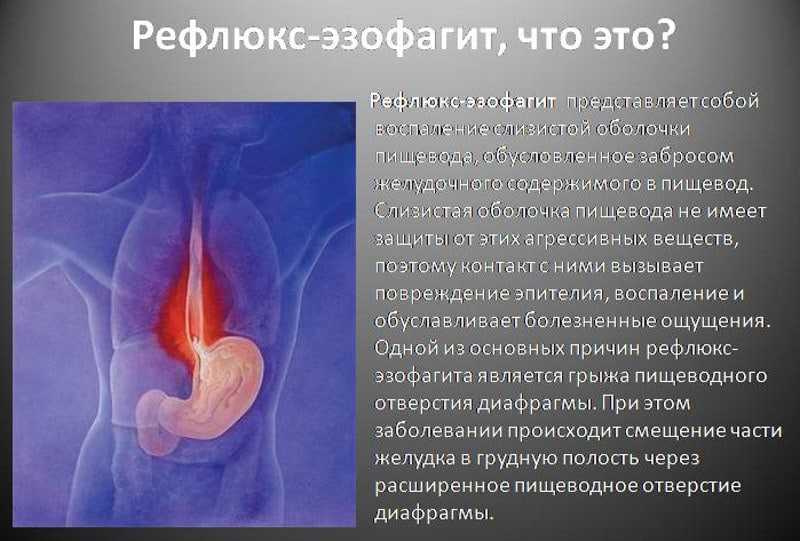 Диета при гастроэзофагеальной рефлюксной болезни