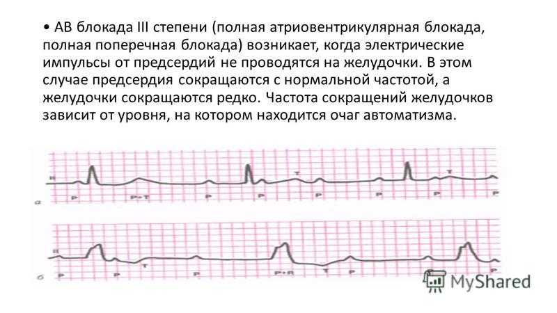Внутрижелудочковые блокады