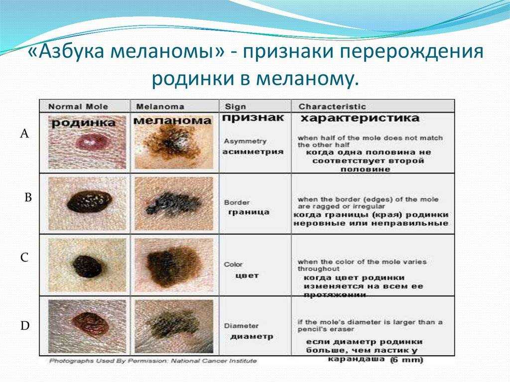 Меланома кожи: симптомы, фото начальной стадии, лечение - medside.ru
